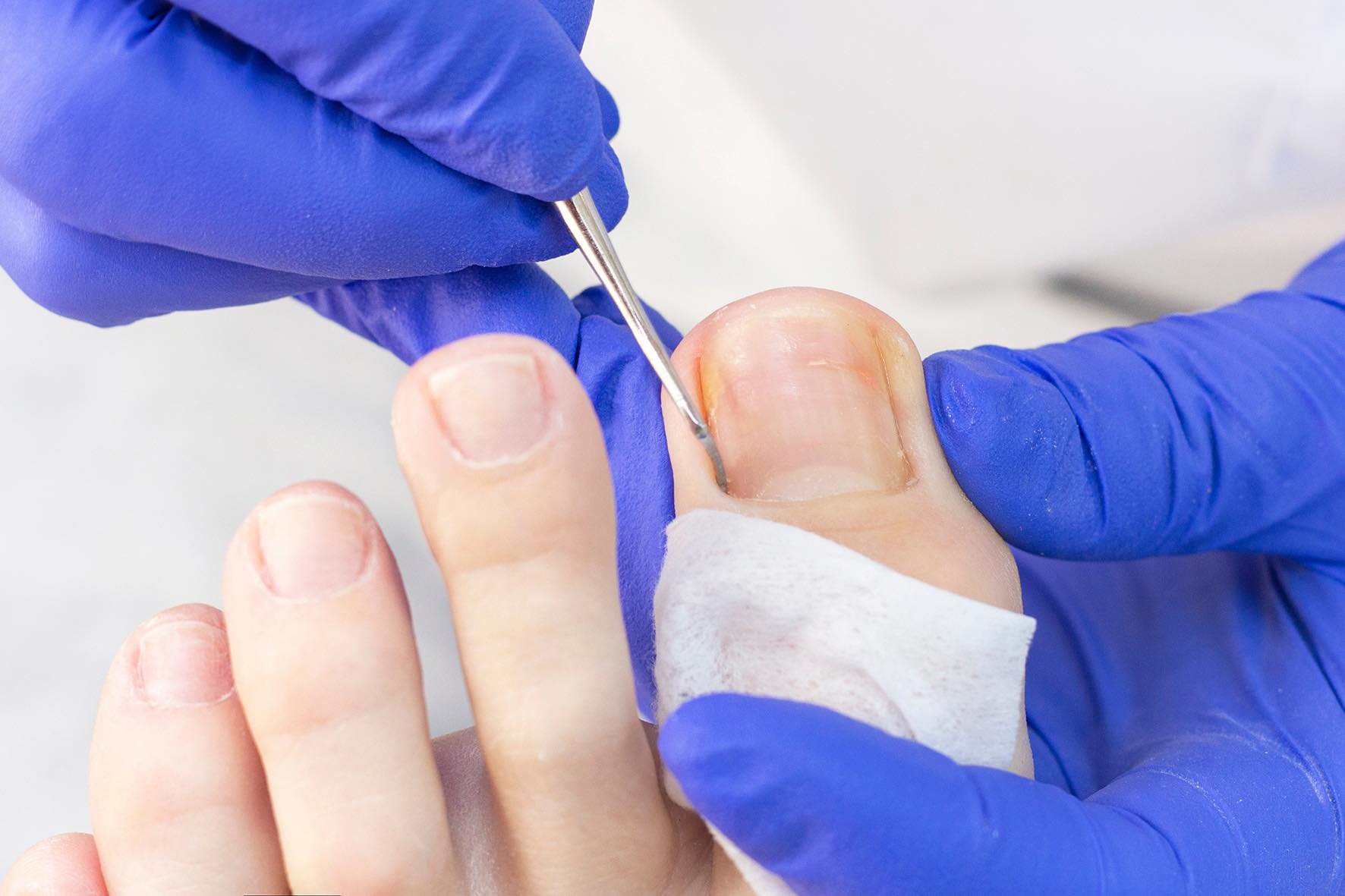 Athletes Foot Practical Tips