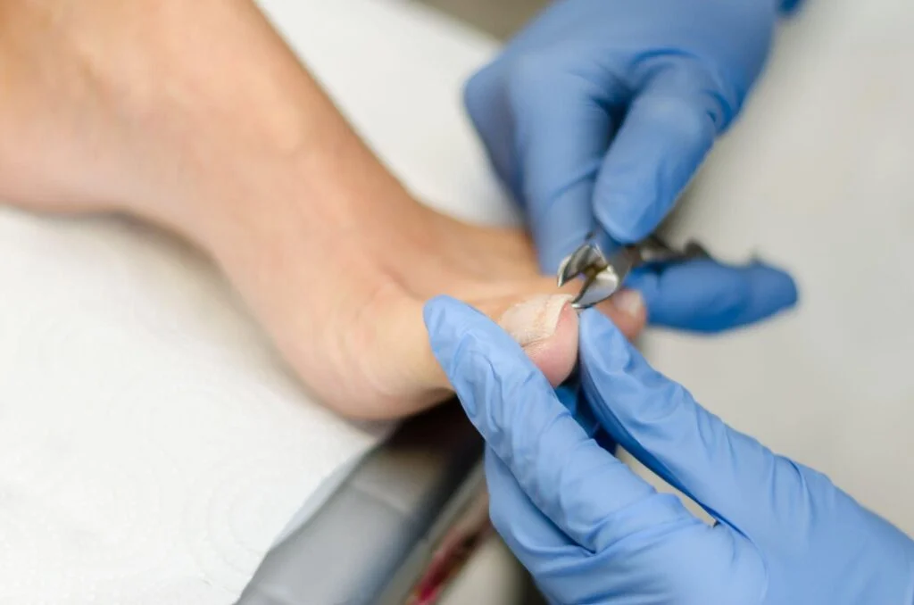 Athletes Foot Safety Tips