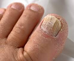 Brittle Toenails A Beginner S Guide