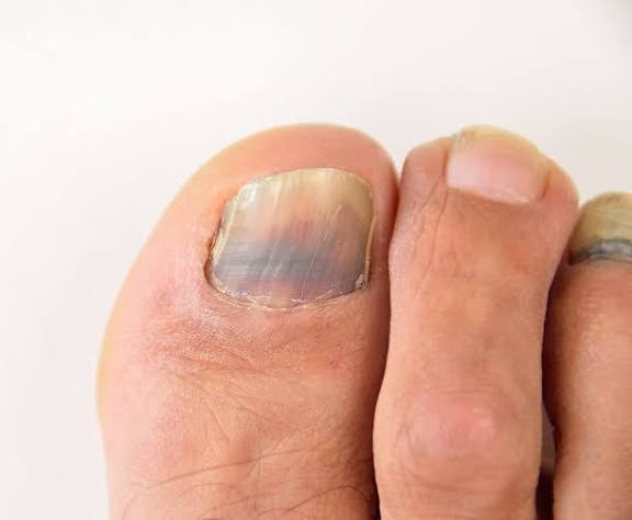 Brittle Toenails Common Questions Answered