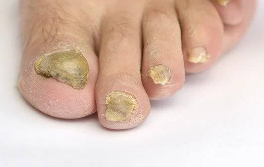 Brittle Toenails Everyday Checklist